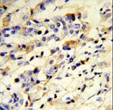 Formalin-fixed and paraffin-embedded human breast carcinoma reacted with IGHM Antibody , which was peroxidase-conjugated to the secondary antibody, followed by DAB staining. This data demonstrates the use of this antibody for immunohistochemistry; clinical relevance has not been evaluated.