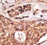 Formalin-fixed and paraffin-embedded human lymph with ICOS Antibody , which was peroxidase-conjugated to the secondary antibody, followed by DAB staining. This data demonstrates the use of this antibody for immunohistochemistry; clinical relevance has not been evaluated.