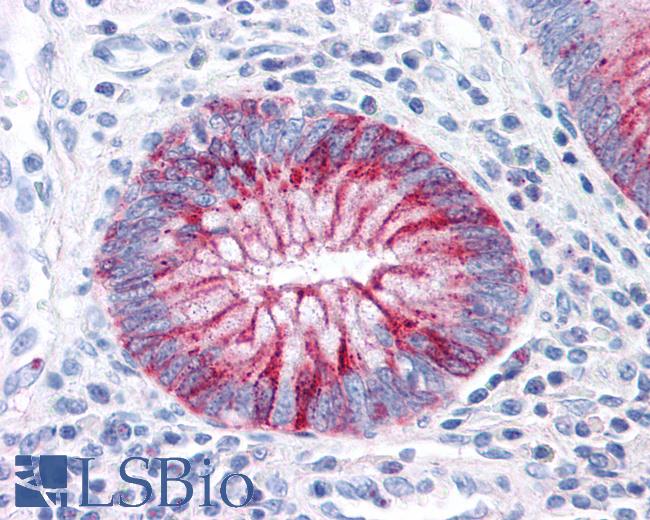 Anti-GPR31 antibody IHC of human Colon, Carcinoma. Immunohistochemistry of formalin-fixed, paraffin-embedded tissue after heat-induced antigen retrieval.