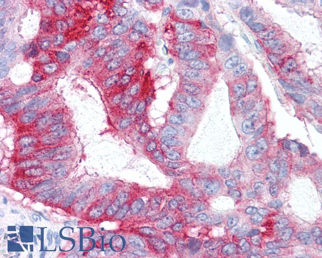 Anti-GPR31 antibody IHC of human Colon, Carcinoma. Immunohistochemistry of formalin-fixed, paraffin-embedded tissue after heat-induced antigen retrieval.