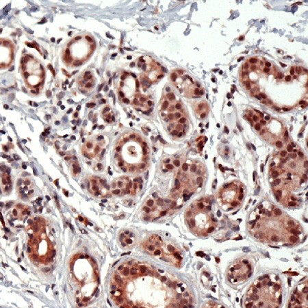Human breast carcinoma stained with Anti-Id2