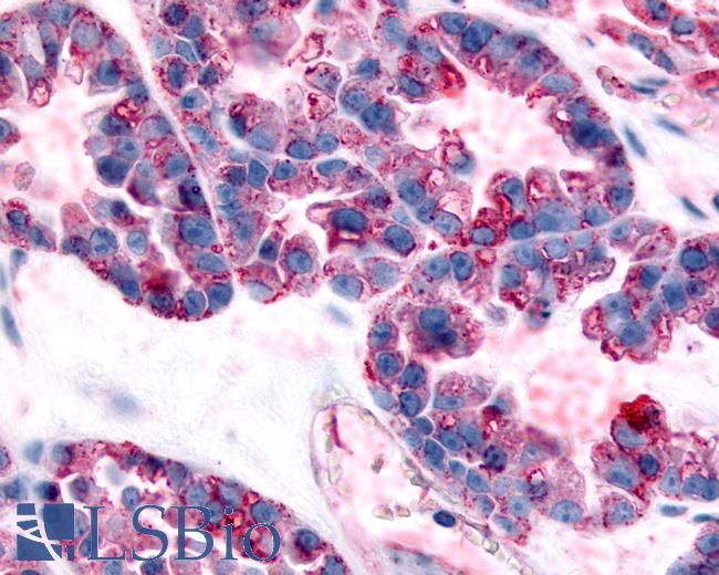 Anti-GPR32 antibody IHC of human Ovary, Carcinoma. Immunohistochemistry of formalin-fixed, paraffin-embedded tissue after heat-induced antigen retrieval.