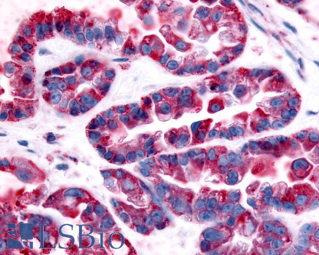 Anti-GPR32 antibody IHC of human Ovary, Carcinoma. Immunohistochemistry of formalin-fixed, paraffin-embedded tissue after heat-induced antigen retrieval.
