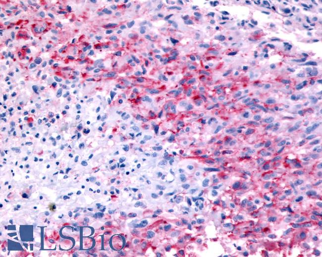 Anti-GPR32 antibody IHC of human Brain, Glioblastoma. Immunohistochemistry of formalin-fixed, paraffin-embedded tissue after heat-induced antigen retrieval.
