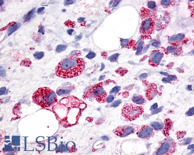 Anti-GPR34 antibody IHC of human Soft Tissue, Liposarcoma. Immunohistochemistry of formalin-fixed, paraffin-embedded tissue after heat-induced antigen retrieval.
