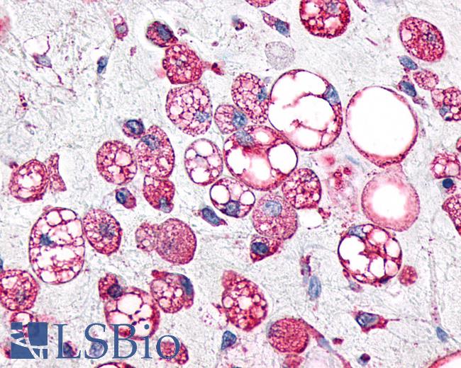 Anti-GPR34 antibody IHC of human Soft Tissue, Liposarcoma. Immunohistochemistry of formalin-fixed, paraffin-embedded tissue after heat-induced antigen retrieval.