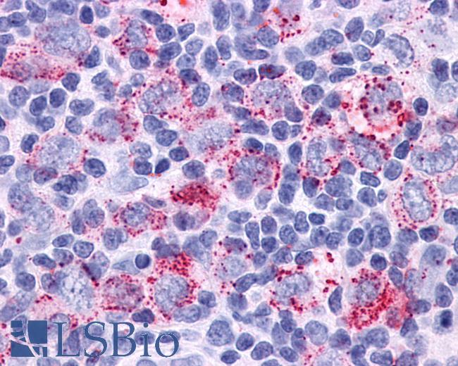 Anti-GPR34 antibody IHC of human Lymph Node, Hodgkins Lymphoma. Immunohistochemistry of formalin-fixed, paraffin-embedded tissue after heat-induced antigen retrieval.