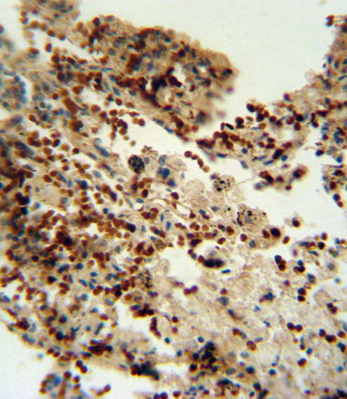 INDO antibody immunohistochemistry of formalin-fixed and paraffin-embedded human lung carcinoma followed by peroxidase-conjugated secondary antibody and DAB staining.