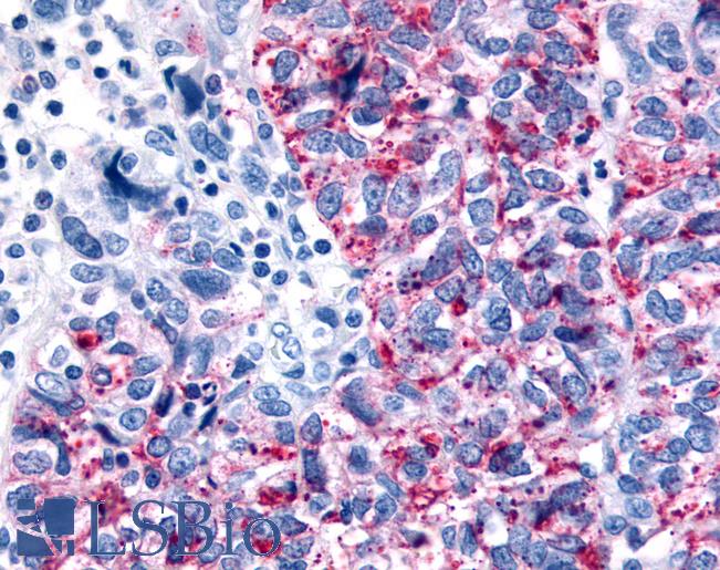 Anti-GPR35 antibody IHC of human Ovary, Carcinoma. Immunohistochemistry of formalin-fixed, paraffin-embedded tissue after heat-induced antigen retrieval.