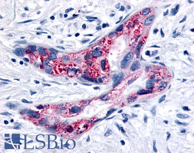 Anti-GPR35 antibody IHC of human Pancreas, Carcinoma. Immunohistochemistry of formalin-fixed, paraffin-embedded tissue after heat-induced antigen retrieval.