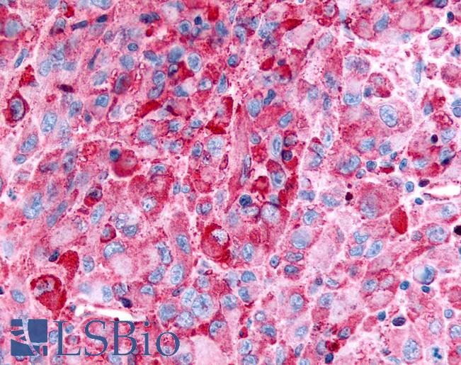 Anti-GPR35 antibody IHC of human Skin, Melanoma. Immunohistochemistry of formalin-fixed, paraffin-embedded tissue after heat-induced antigen retrieval.