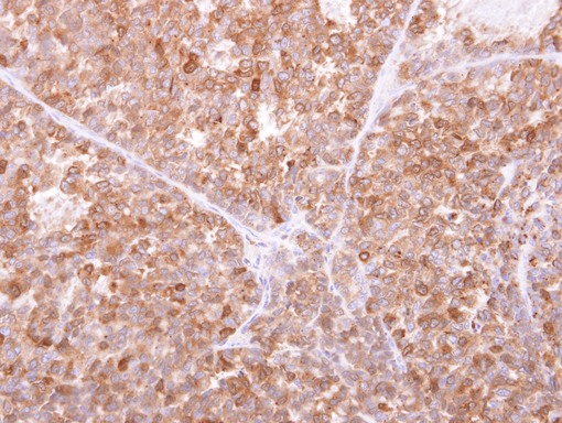 GILT antibody detects IFI30 protein at cytosol on AGS xenograft by immunohistochemical analysis. Sample: Paraffin-embedded AGS xenograft. GILT antibody dilution:1:500.