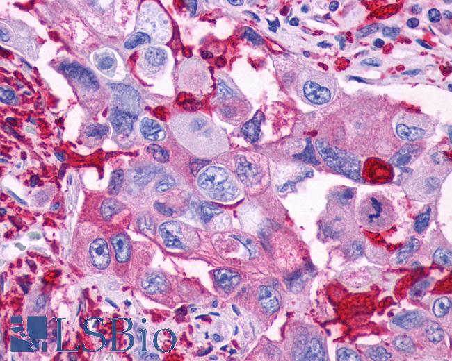 Anti-GPR39 antibody IHC of human Pancreas, Carcinoma. Immunohistochemistry of formalin-fixed, paraffin-embedded tissue after heat-induced antigen retrieval.