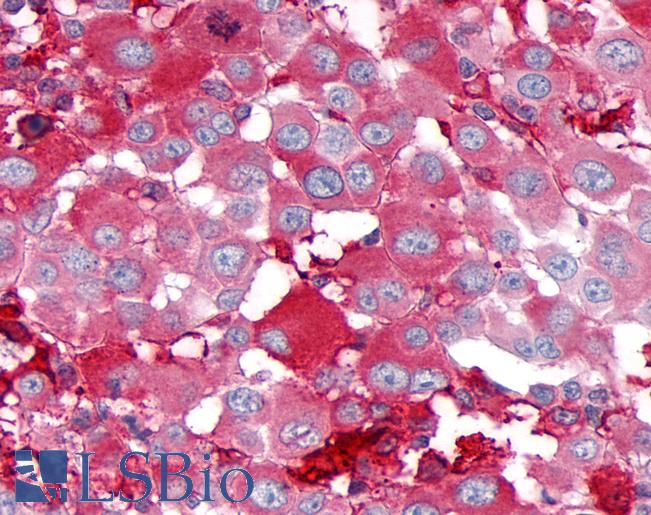 Anti-GPR39 antibody IHC of human Skin, Melanoma. Immunohistochemistry of formalin-fixed, paraffin-embedded tissue after heat-induced antigen retrieval.