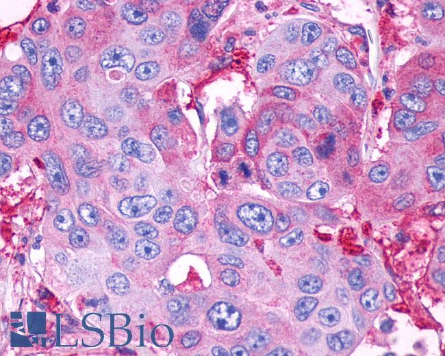 Anti-GPR39 antibody IHC of human Colon, Carcinoma. Immunohistochemistry of formalin-fixed, paraffin-embedded tissue after heat-induced antigen retrieval.