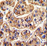 Formalin-fixed and paraffin-embedded human hepatocarcinoma with IFNAR1 Antibody , which was peroxidase-conjugated to the secondary antibody, followed by DAB staining. This data demonstrates the use of this antibody for immunohistochemistry; clinical relevance has not been evaluated.
