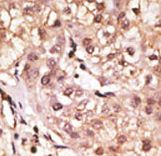 Formalin-fixed and paraffin-embedded human cancer tissue reacted with the primary antibody, which was peroxidase-conjugated to the secondary antibody, followed by DAB staining. This data demonstrates the use of this antibody for immunohistochemistry; clinical relevance has not been evaluated. BC = breast carcinoma; HC = hepatocarcinoma.