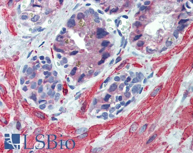 Anti-IGFBP4 antibody IHC of human prostate. Immunohistochemistry of formalin-fixed, paraffin-embedded tissue after heat-induced antigen retrieval. Antibody LS-B3992 concentration 5 ug/ml.