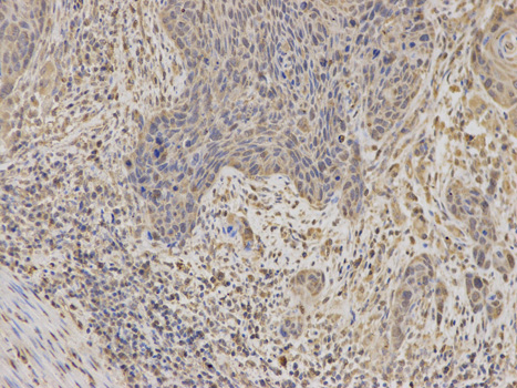 Immunohistochemistry of paraffin-embedded human esophageal cancer using IGFBP5 antibody at dilution of 1:100 (200x lens).