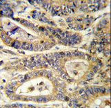 Formalin-fixed and paraffin-embedded human colon carcinoma reacted with IGFBP6 Antibody , which was peroxidase-conjugated to the secondary antibody, followed by DAB staining. This data demonstrates the use of this antibody for immunohistochemistry; clinical relevance has not been evaluated.