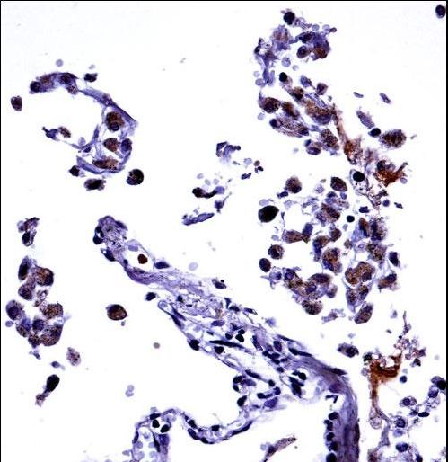 IL13 Antibody immunohistochemistry of formalin-fixed and paraffin-embedded human lung tissue followed by peroxidase-conjugated secondary antibody and DAB staining.
