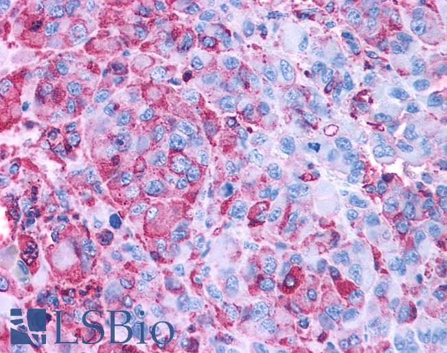 Anti-GPR50 antibody IHC of human Skin, Melanoma. Immunohistochemistry of formalin-fixed, paraffin-embedded tissue after heat-induced antigen retrieval.