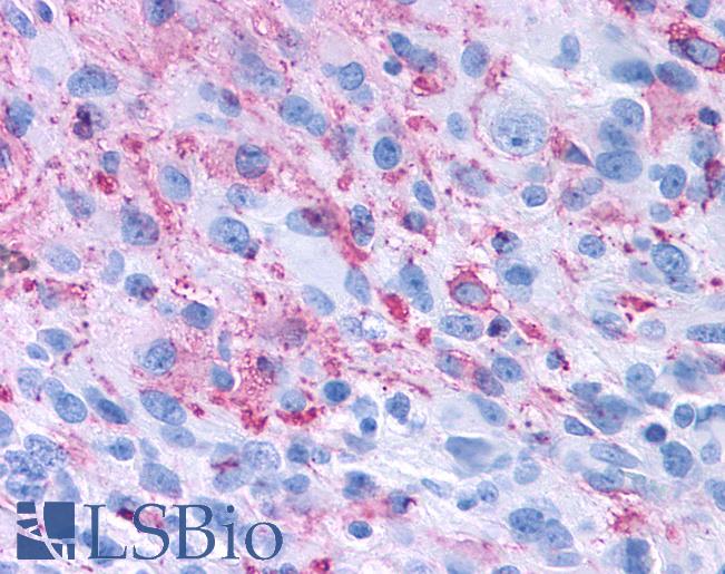Anti-GPR50 antibody IHC of human Brain, Glioblastoma. Immunohistochemistry of formalin-fixed, paraffin-embedded tissue after heat-induced antigen retrieval.