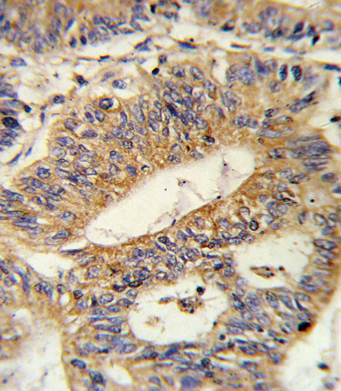 Formalin-fixed and paraffin-embedded human colon carcinoma reacted with IL17RB Antibody , which was peroxidase-conjugated to the secondary antibody, followed by DAB staining. This data demonstrates the use of this antibody for immunohistochemistry; clinical relevance has not been evaluated.