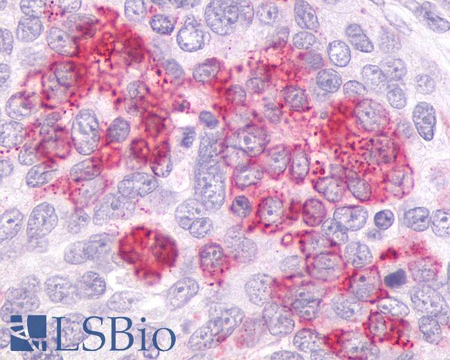Anti-GPR55 antibody IHC of human Ovary, Carcinoma. Immunohistochemistry of formalin-fixed, paraffin-embedded tissue after heat-induced antigen retrieval.