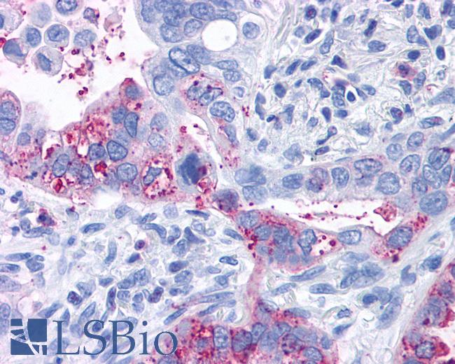 Anti-GPR6 antibody IHC of human Lung, Adenocarcinoma. Immunohistochemistry of formalin-fixed, paraffin-embedded tissue after heat-induced antigen retrieval.