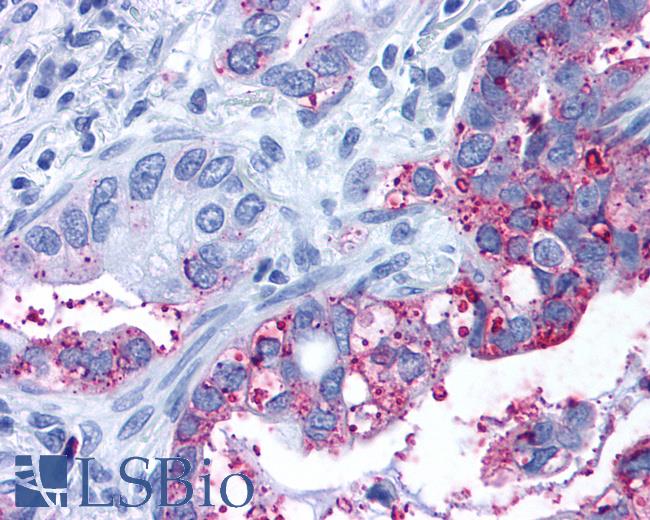 Anti-GPR6 antibody IHC of human Lung, Adenocarcinoma. Immunohistochemistry of formalin-fixed, paraffin-embedded tissue after heat-induced antigen retrieval.