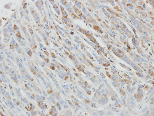 IHC of paraffin-embedded PC3 xenograft using IL1 Receptor antagonist antibody at 1:500 dilution.