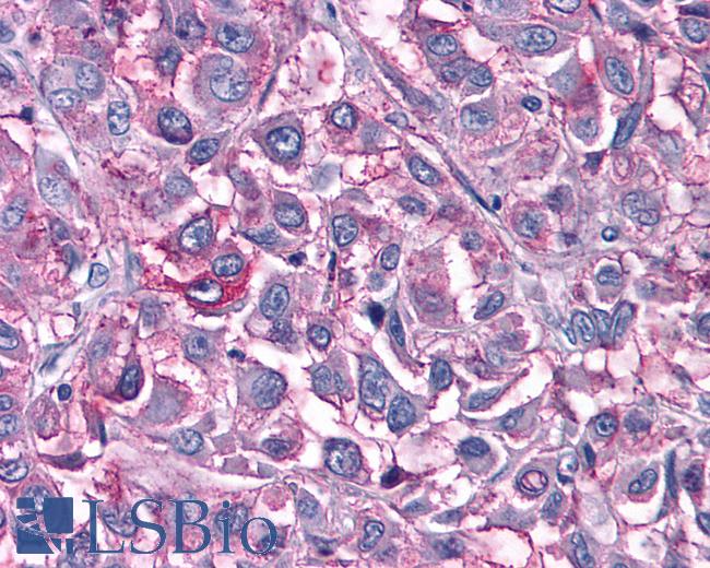 Anti-GPR6 antibody IHC of human Skin, Melanoma. Immunohistochemistry of formalin-fixed, paraffin-embedded tissue after heat-induced antigen retrieval.