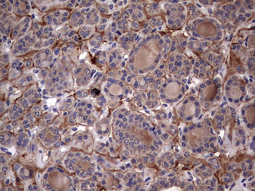 IHC of paraffin-embedded Carcinoma of Human thyroid tissue using anti-IL1RN mouse monoclonal antibody. (Heat-induced epitope retrieval by 1 mM EDTA in 10mM Tris, pH8.5, 120°C for 3min).