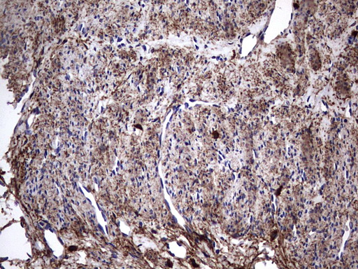 IHC of paraffin-embedded Adenocarcinoma of Human endometrium tissue using anti-IL1RN mouse monoclonal antibody. (Heat-induced epitope retrieval by 1 mM EDTA in 10mM Tris, pH8.5, 120°C for 3min).