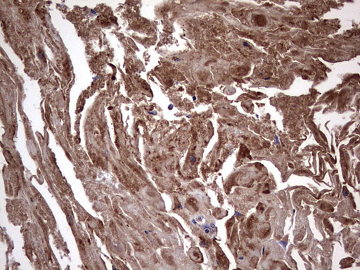 IHC of paraffin-embedded Carcinoma of Human bladder tissue using anti-IL1RN mouse monoclonal antibody. (Heat-induced epitope retrieval by 1 mM EDTA in 10mM Tris, pH8.5, 120°C for 3min).