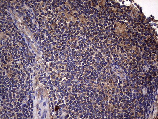 IHC of paraffin-embedded Human lymphoma tissue using anti-IL1RN mouse monoclonal antibody. (Heat-induced epitope retrieval by 1 mM EDTA in 10mM Tris, pH8.5, 120°C for 3min).