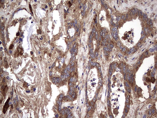 IHC of paraffin-embedded Adenocarcinoma of Human colon tissue using anti-IL1RN mouse monoclonal antibody. (Heat-induced epitope retrieval by 1 mM EDTA in 10mM Tris, pH8.5, 120°C for 3min).