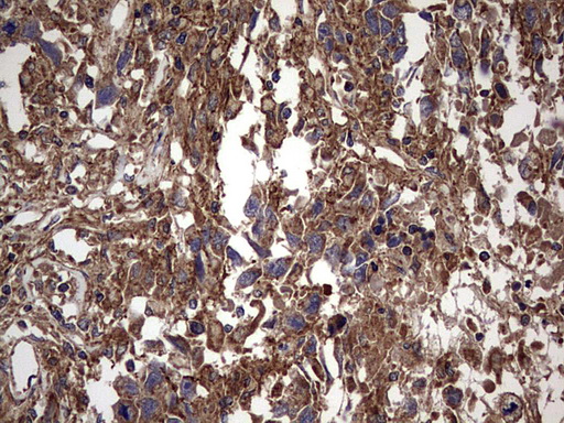 IHC of paraffin-embedded Adenocarcinoma of Human ovary tissue using anti-IL1RN mouse monoclonal antibody. (Heat-induced epitope retrieval by 1 mM EDTA in 10mM Tris, pH8.5, 120°C for 3min).