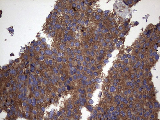 IHC of paraffin-embedded Adenocarcinoma of Human breast tissue using anti-IL1RN mouse monoclonal antibody. (Heat-induced epitope retrieval by 1 mM EDTA in 10mM Tris, pH8.5, 120°C for 3min).