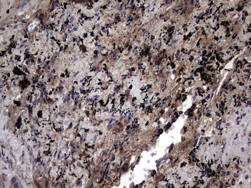 IHC of paraffin-embedded Carcinoma of Human lung tissue using anti-IL1RN mouse monoclonal antibody. (Heat-induced epitope retrieval by 1 mM EDTA in 10mM Tris, pH8.5, 120°C for 3min).