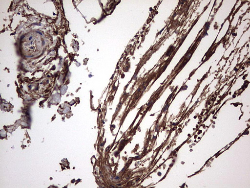 IHC of paraffin-embedded Carcinoma of Human kidney tissue using anti-IL1RN mouse monoclonal antibody. (Heat-induced epitope retrieval by 1 mM EDTA in 10mM Tris, pH8.5, 120°C for 3min).