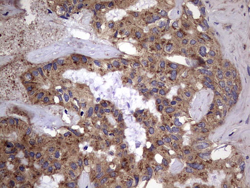 IHC of paraffin-embedded Carcinoma of Human liver tissue using anti-IL1RN mouse monoclonal antibody. (Heat-induced epitope retrieval by 1 mM EDTA in 10mM Tris, pH8.5, 120°C for 3min).