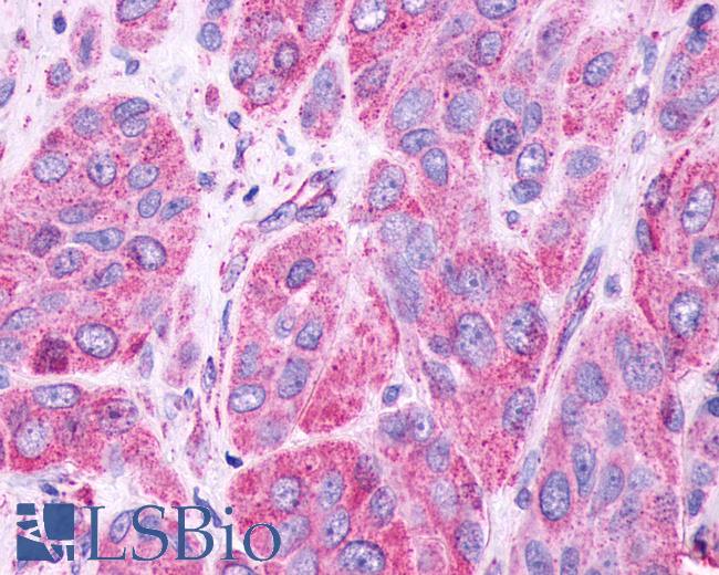 Anti-GPR61 antibody IHC of human Skin, Melanoma. Immunohistochemistry of formalin-fixed, paraffin-embedded tissue after heat-induced antigen retrieval.