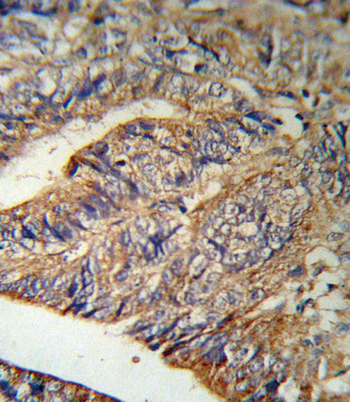 IL1RN Antibody (RB18901) IHC of formalin-fixed and paraffin-embedded human Colon carcinoma followed by peroxidase-conjugated secondary antibody and DAB staining.