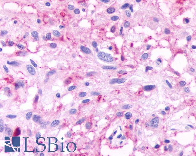 Anti-GPR61 antibody IHC of human Brain, Glioblastoma. Immunohistochemistry of formalin-fixed, paraffin-embedded tissue after heat-induced antigen retrieval.