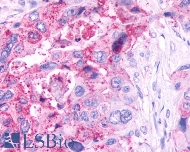 Anti-GPR61 antibody IHC of human Pancreas, Carcinoma. Immunohistochemistry of formalin-fixed, paraffin-embedded tissue after heat-induced antigen retrieval.