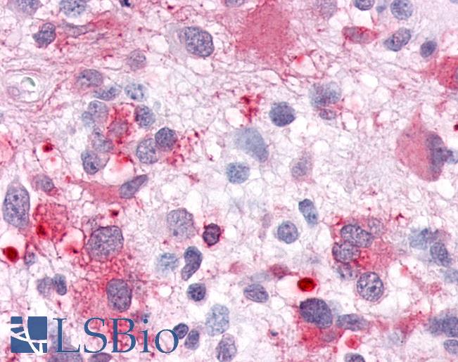 Anti-GPR63 antibody IHC of human Brain, Glioblastoma. Immunohistochemistry of formalin-fixed, paraffin-embedded tissue after heat-induced antigen retrieval.