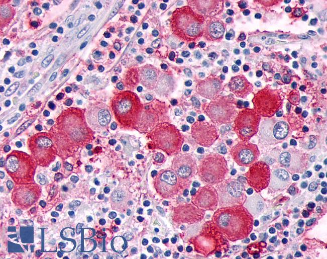 Anti-GPR63 antibody IHC of human Skin, Melanoma. Immunohistochemistry of formalin-fixed, paraffin-embedded tissue after heat-induced antigen retrieval.