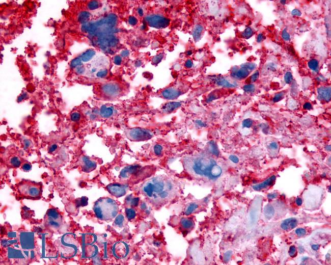 Anti-GPR63 antibody IHC of human Brain, Glioblastoma. Immunohistochemistry of formalin-fixed, paraffin-embedded tissue after heat-induced antigen retrieval.